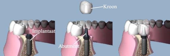 https://afbeeldingen.dekliniekvoortandheelkunde.nl/production/algemeen/6.jpg?w=570&h=190&auto=compress%2Cformat&fit=crop&dm=1769597633&s=63859f1c3bd169acd6889c9f6a416367