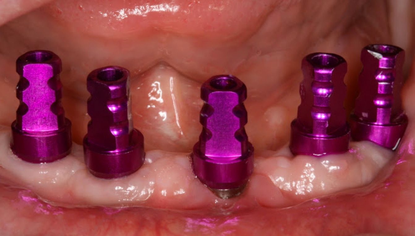 https://afbeeldingen.dekliniekvoortandheelkunde.nl/production/algemeen/afdrukstiften_in_situ.jpg?w=1342&h=766&auto=compress%2Cformat&fit=crop&dm=1769597638&s=a2d8be27901edf4eb6a38e85e3e2e1c1
