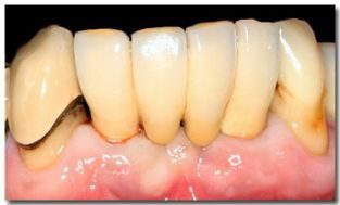 https://afbeeldingen.dekliniekvoortandheelkunde.nl/production/algemeen/brug_op_implantaten_small.jpg?w=313&h=189&auto=compress%2Cformat&fit=crop&dm=1769597640&s=cd1dc33ec21b5aa09832b781aaced8b4
