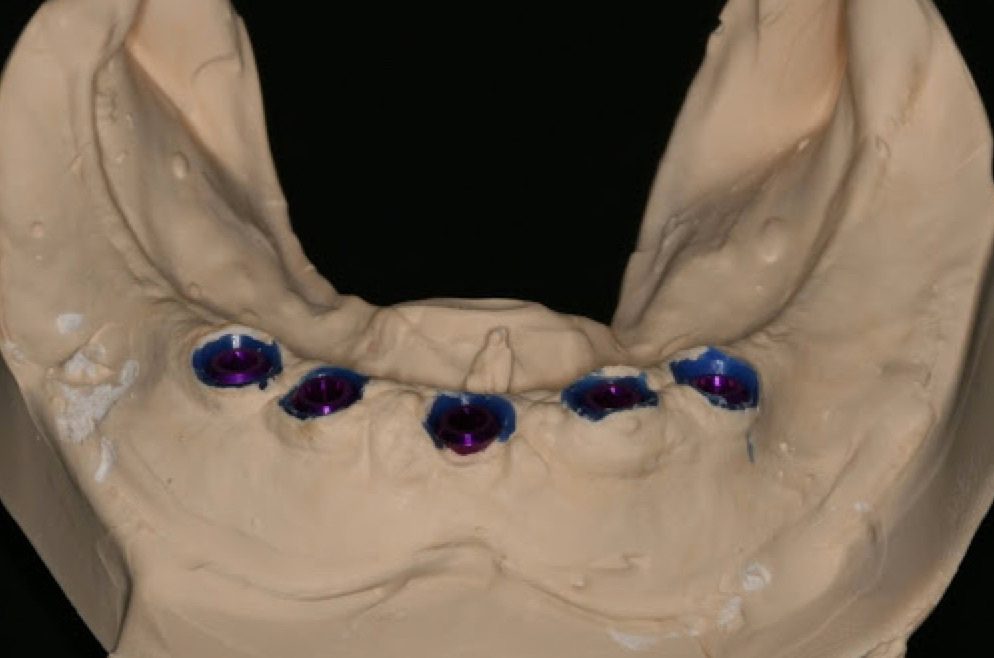 https://afbeeldingen.dekliniekvoortandheelkunde.nl/production/algemeen/gipsmodel.jpg?w=994&h=658&auto=compress%2Cformat&fit=crop&dm=1769597645&s=01cf89e3951afa5d437df1abebeb98e6