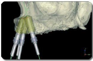 https://afbeeldingen.dekliniekvoortandheelkunde.nl/production/algemeen/implantaat_planning_op_ct_scan_small.jpeg?w=313&h=206&auto=compress%2Cformat&fit=crop&dm=1769597645&s=f17c365608acc34538b7253c2670b1ae