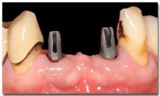 https://afbeeldingen.dekliniekvoortandheelkunde.nl/production/algemeen/implantaten_small.jpeg?w=313&h=187&auto=compress%2Cformat&fit=crop&dm=1769597645&s=4661c72a0369bbb6239f5802ec13181c