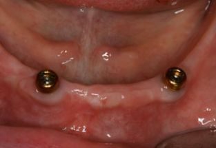 https://afbeeldingen.dekliniekvoortandheelkunde.nl/production/algemeen/klikgebit_op_drukknoppen_small.jpeg?w=313&h=215&auto=compress%2Cformat&fit=crop&dm=1769597646&s=5a92c44a234b439a5fc29fb37c72f57f