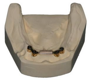 https://afbeeldingen.dekliniekvoortandheelkunde.nl/production/algemeen/klikgebit_op_een_steg_of_staaf-1_small.jpg?w=313&h=272&auto=compress%2Cformat&fit=crop&dm=1769597646&s=ac441a94bc78a6d82e52d46a231fb8b7