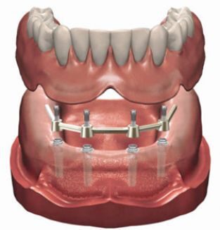 https://afbeeldingen.dekliniekvoortandheelkunde.nl/production/algemeen/klikgebit_op_een_steg_of_staaf_small.jpg?w=313&h=326&auto=compress%2Cformat&fit=crop&dm=1769597647&s=07361ab94487f895c8aab31f9f69e93a