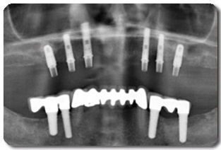 https://afbeeldingen.dekliniekvoortandheelkunde.nl/production/algemeen/planning_op_opg_small.jpeg?w=313&h=212&auto=compress%2Cformat&fit=crop&dm=1769597648&s=53218e21aa35efbe102e2947ea501e90