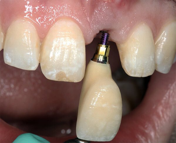 https://afbeeldingen.dekliniekvoortandheelkunde.nl/production/algemeen/verschroefde_kroon.jpg?w=600&h=489&auto=compress%2Cformat&fit=crop&dm=1769597651&s=ff624d5e5505f09afc737614ce1a6363
